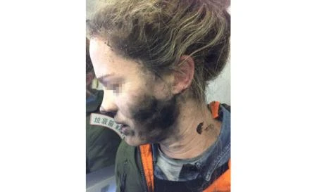 This handout photo taken on February 19, 2017 and released by the Australia Transport Safety Bureau (ATSB) shows a woman after she suffered burns to her face and hands after her headphones caught fire during a flight to Australia, officials said on March 15, 2017. (AFP)