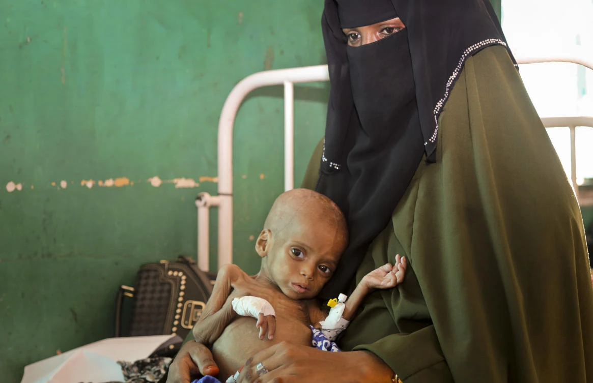 Acutely malnourished child is treated at the Bandar Hospital. (AP)