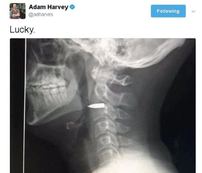 ABC journalist Adam Harvey shared a photo of the x-ray which shows the bullet lodged behind his jaw. (Photo courtesy: Twitter)