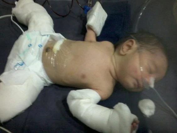Baby in India born with twin inside him in rare defect