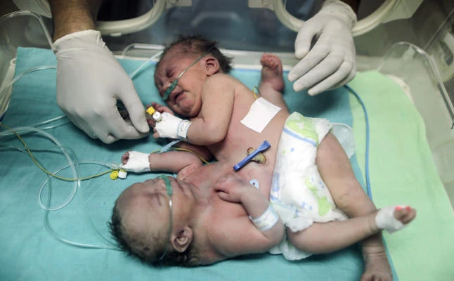 Palestinian conjoined twins lie in an incubator at the nursery on October 22, 2017 at al-Shifa Hospital in Gaza City. (AFP / MAHMUD HAMS)