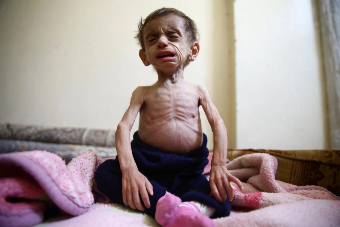 Above, two-and-a-half year old Hala Al-Nufi, who suffers from a metabolic disorder which is worsening due to the siege and food shortages in the eastern Ghouta. (Reuters)