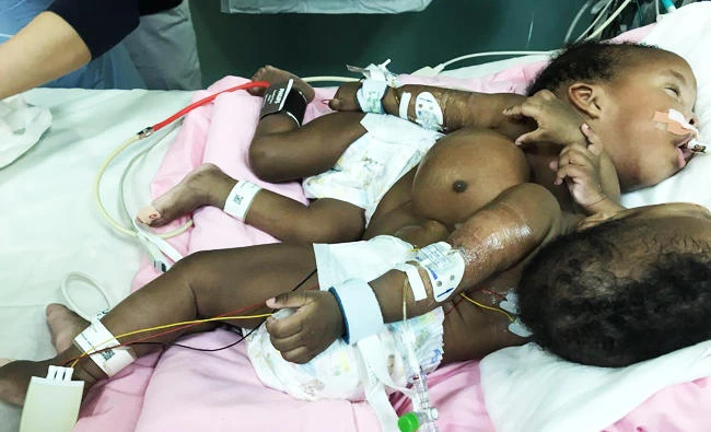 The twins are 13-month-old females who are joined at the chest and abdomen. (SPA)