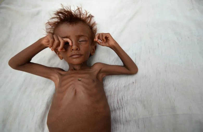 More than 155 million children aged under five are stunted due to lack of nutrition, and 52 million are defined as “wasted” — meaning they do not weigh enough for their height. (Reuters)