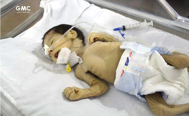An undernourished infant receives treatment in a hospital in Ghouta, near Damascus. (AP)
