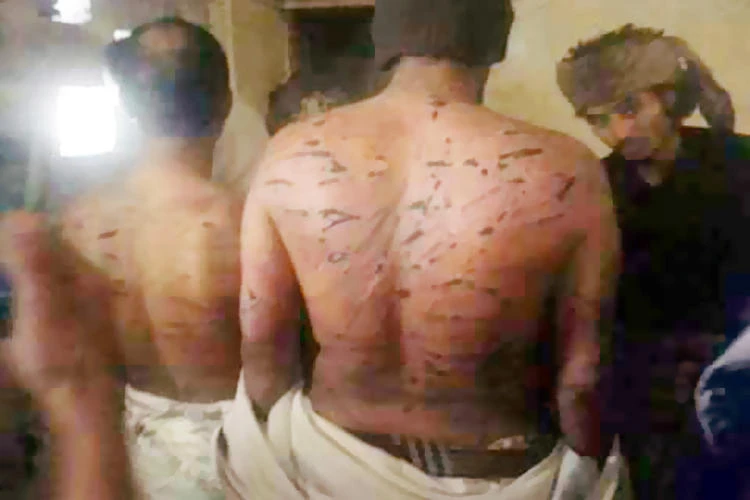 Victims of Houthis’ torture during detention show their injuries.