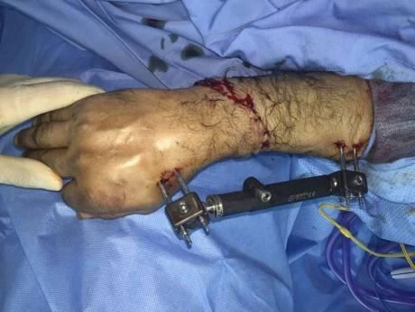 Saudi doctors reattach hand severed in freak accident. (Social media)