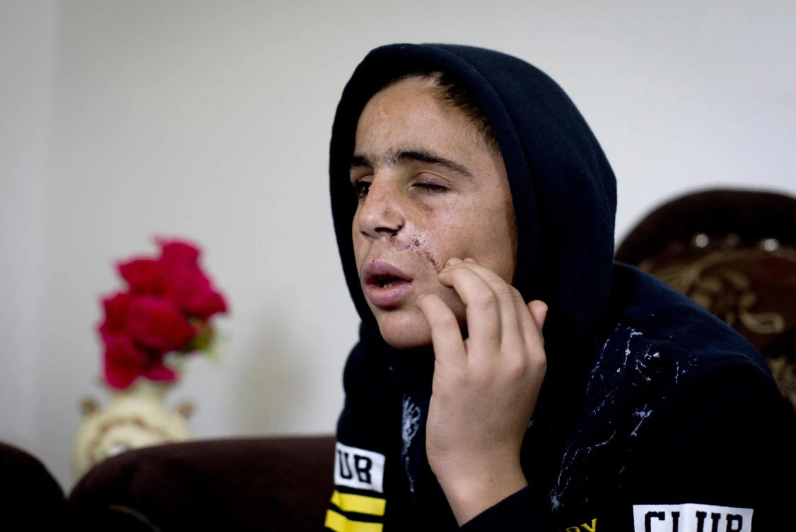 Mohammed Tamimi, Ahed Tamimi’s 15-year-old cousin sits in his family home in Nabi Saleh, recovering from a serious head injury sustained after being shot with a rubber-coated metal bullet in clashes with Israeli troops. Relatives of Ahed Tamimi, the Palestinian teen-turned-protest icon, said that troops arrested 10 people from her West Bank village, including Mohammed. (AP Photo)