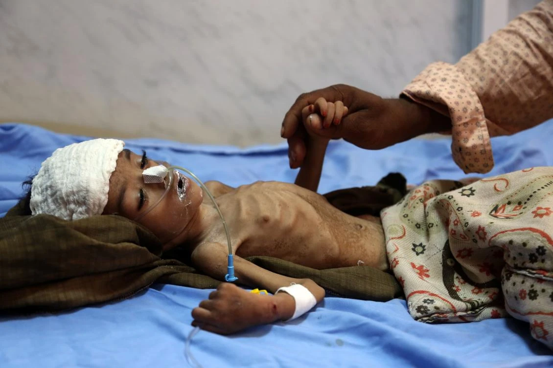 File photo showing a child hospitalized with malnourishment at a hospital in Yemeni port city of Hodeidah. (AFP)