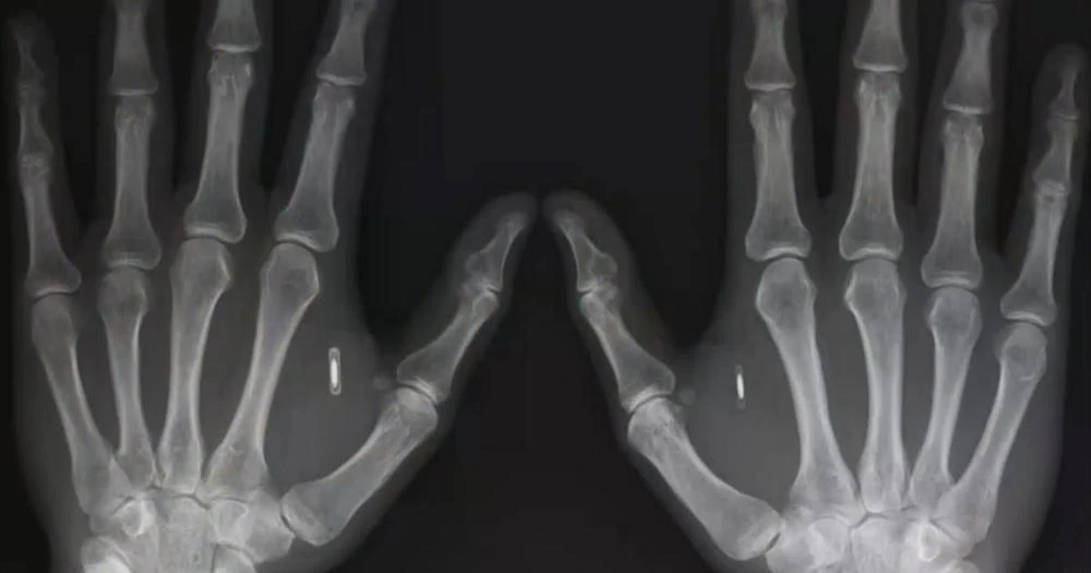 Microchips get under the skin of technophile Swedes