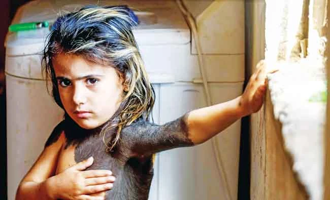 Haura, a 4-year-old Iraqi child, in the village of Wahed Haziran, Diwaniya province, has a rare skin disease that covers much of her upper body in black marks and hair. AFP