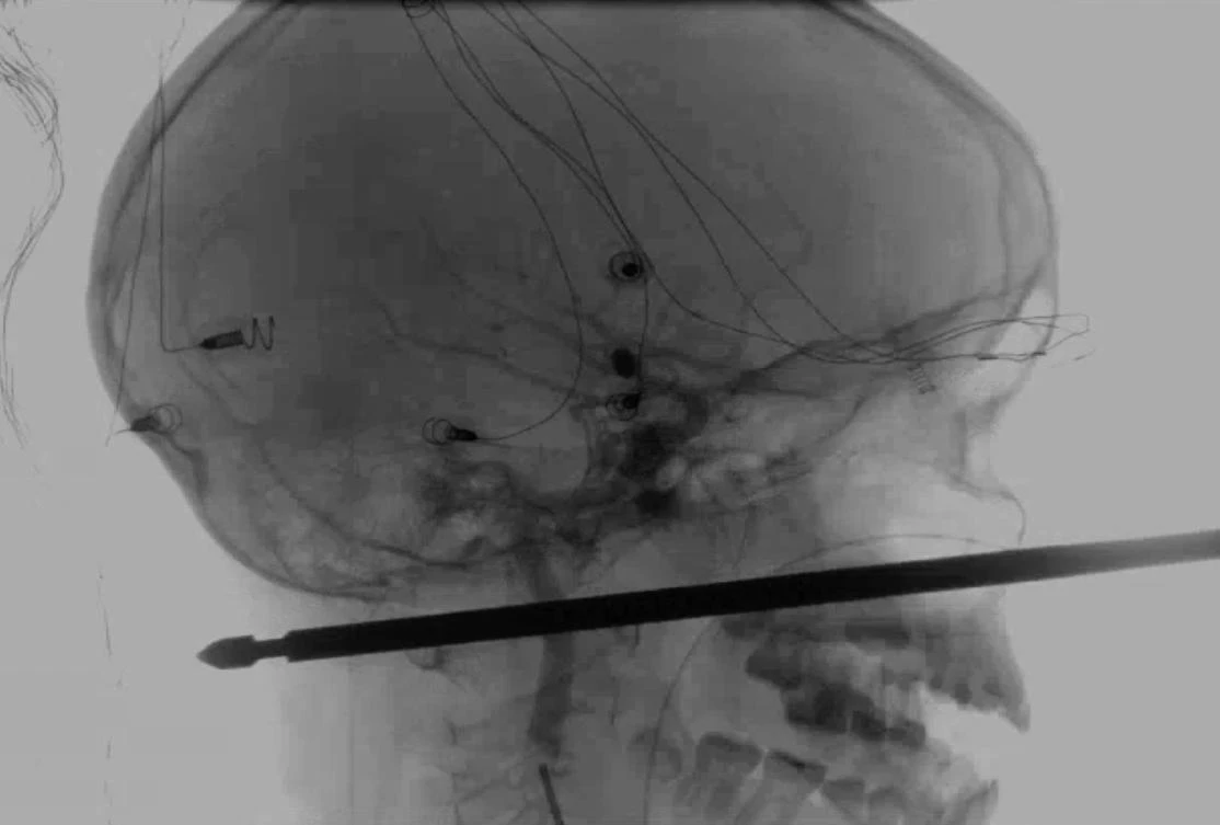 This X-ray provided by the Medical News Network shows a meat skewer impaled in the skull of Xavier Cunningham after an accident at his home Saturday, Sept. 8, 2018, in Harrisonville, Mo. Cunningham's experience began when yellow jackets attacked him in a tree house and he tumbled from the tree, landing on the skewer. (AP)