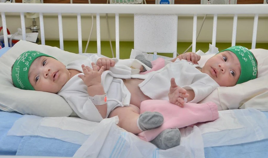 Saudi Siamese twins to be separated on Thursday