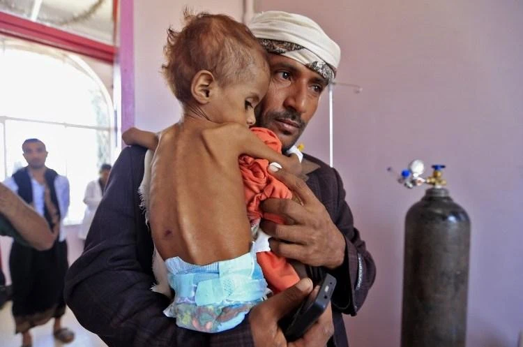 A Yemeni man carries his child who is suffering from malnutrition into a treatment center at a hospital in Sanaa. (AFP)