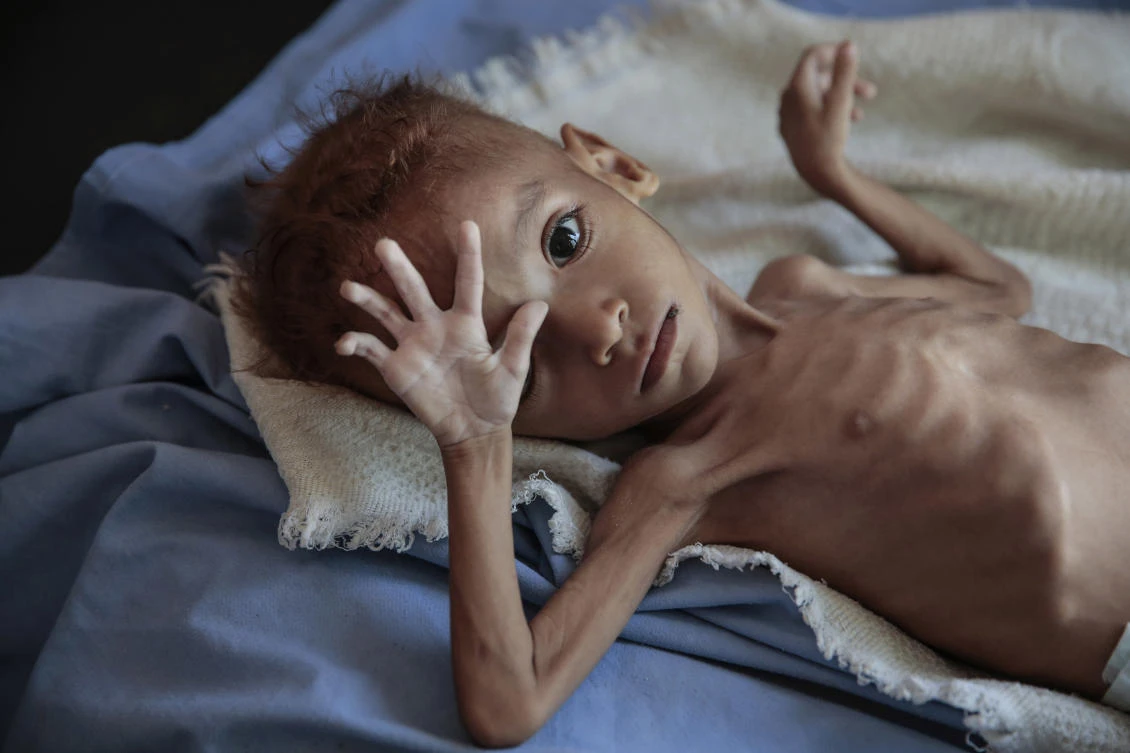 In this Oct. 1, 2018, file, photo, a severely malnourished boy rests on a hospital bed at the Aslam Health Center, Hajjah, Yemen. (AP)