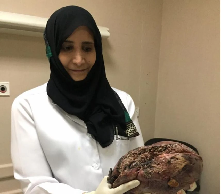 Saudi female surgeon leads operation to remove rare liver tumor