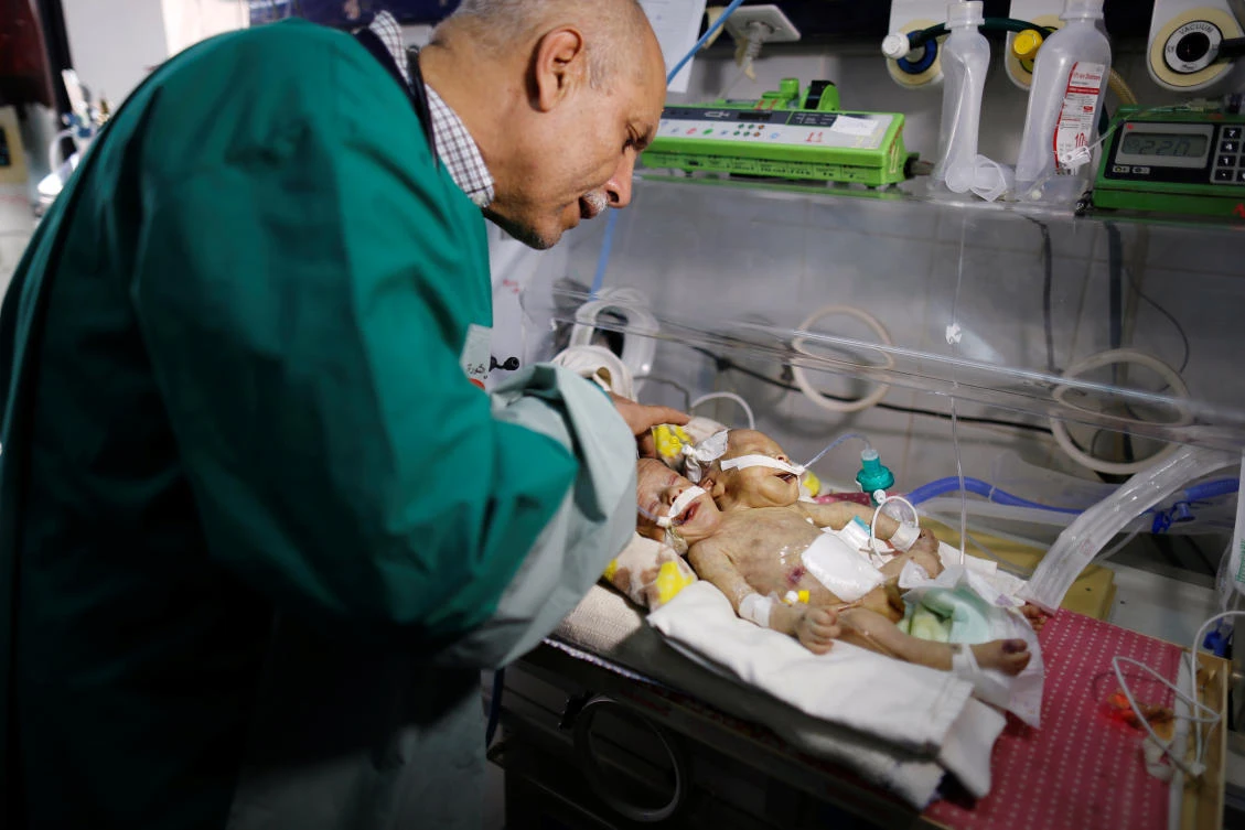 A doctor checks newly born conjoined twins as they lie in an incubator at the child intensive care unit of Al-Thawra hospital in Sanaa. (Reuters)