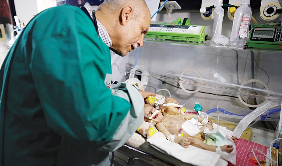 The two little boys, Abdelkhaleq and Abdelkarim, share a kidney and two legs but have separate hearts and lungs. (AP)