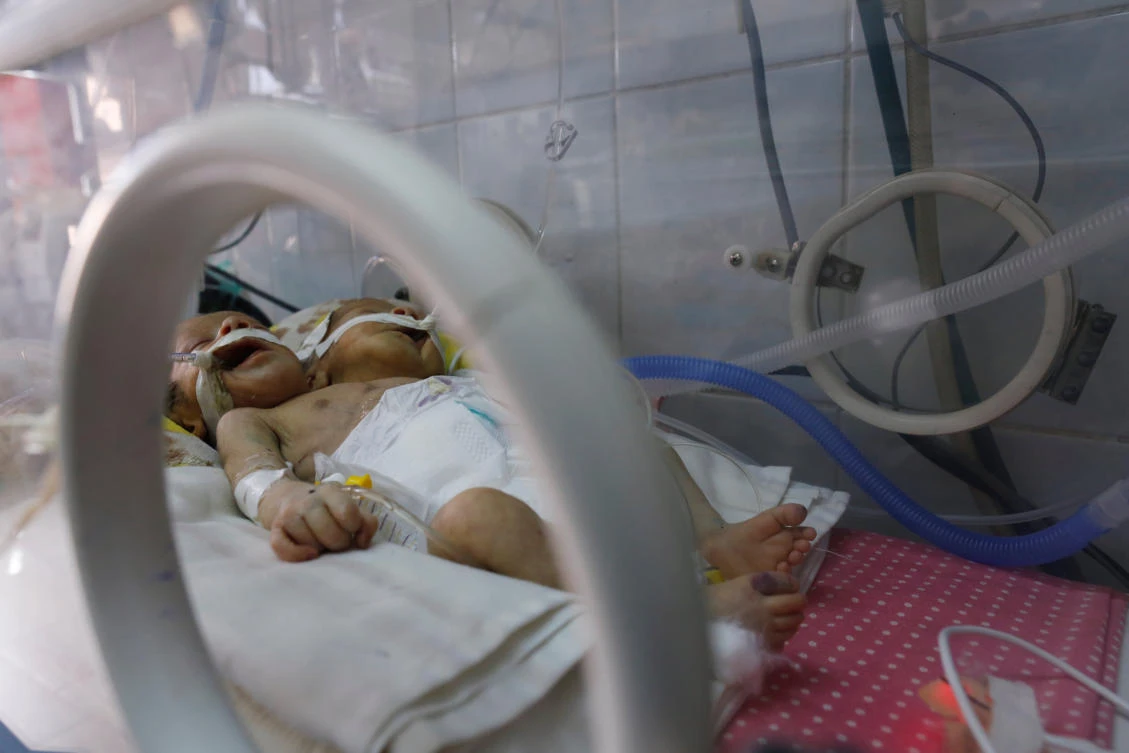 Newly born conjoined twins lie in an incubator at the child intensive care unit of al-Thawra hospital in Sanaa, Yemen February 6, 2019. (Reuters)