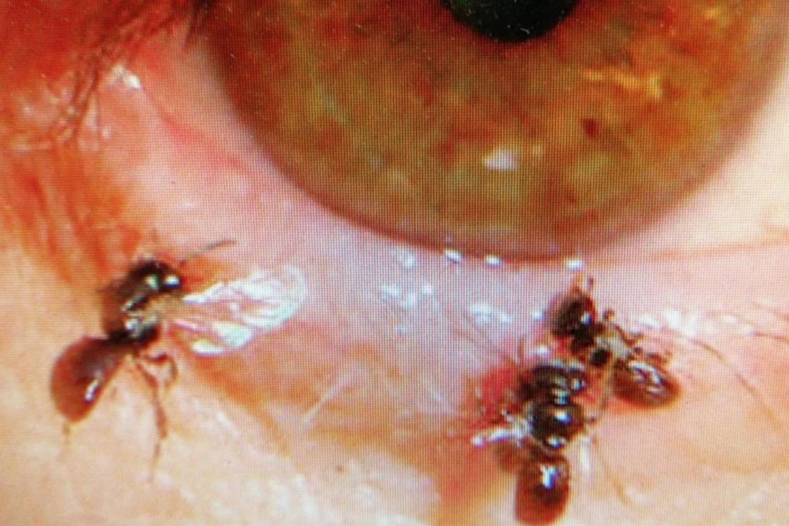 Four tiny “sweat bees” that had been living in a Taiwanese woman’s eye were removed by a doctor who described his surprise at finding a “leg with hair, protruding from the eyelid.” (AFP)