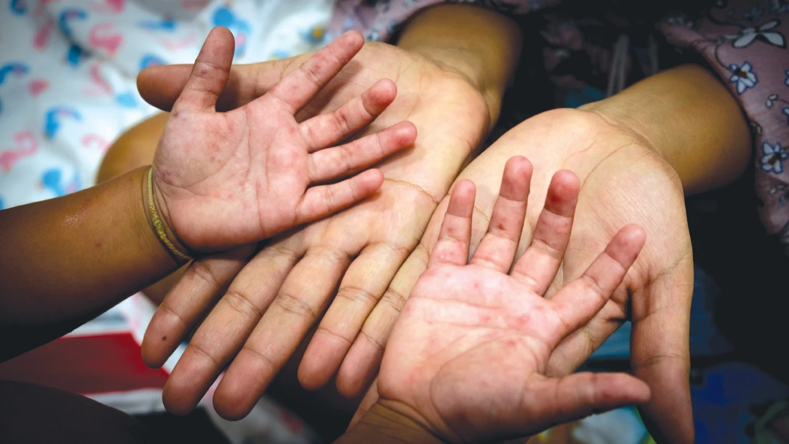 Why measles is making a deadly return