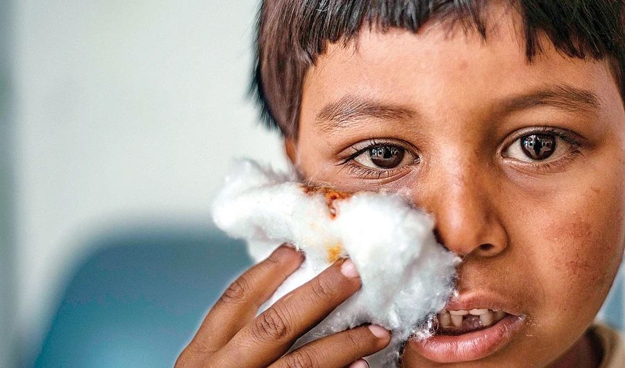 A Syrian boy holds a cotton wool over his cheek after receiving treatment for a skin disease at a health center in Karama, near Raqqa, on April 16. (AFP)