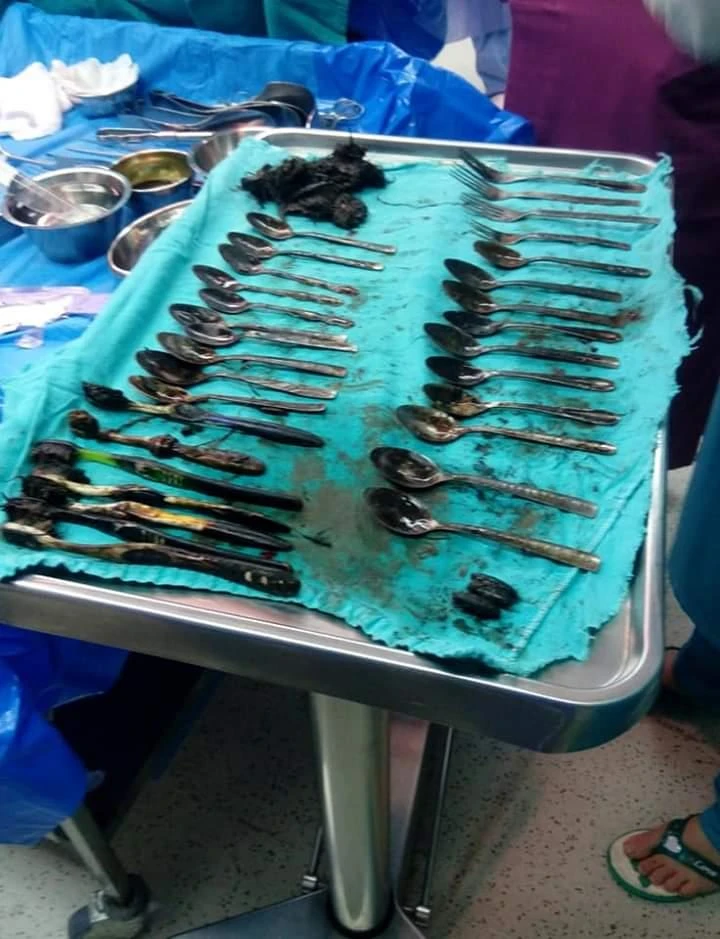 Egyptian surgeons recover 20 spoons from patient’s stomach
