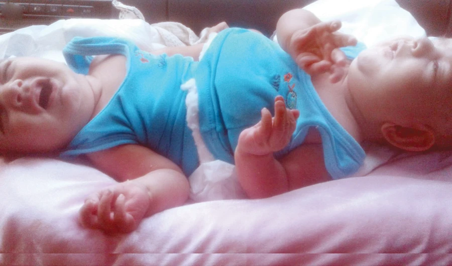 The case of Ahmed and Mohammed is being studied as part of the Saudi National Siamese Twins Separation Program. (SPA)