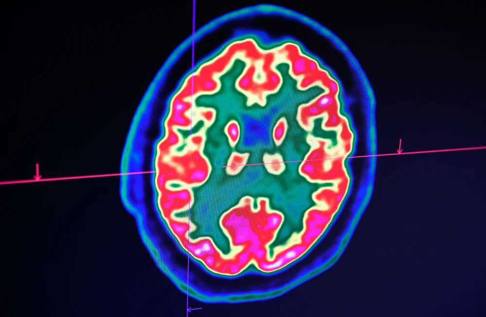 The effects of the coronavirus on the human brain are ‘variable,’ according to one specialist, but can be dramatic. (AFP)