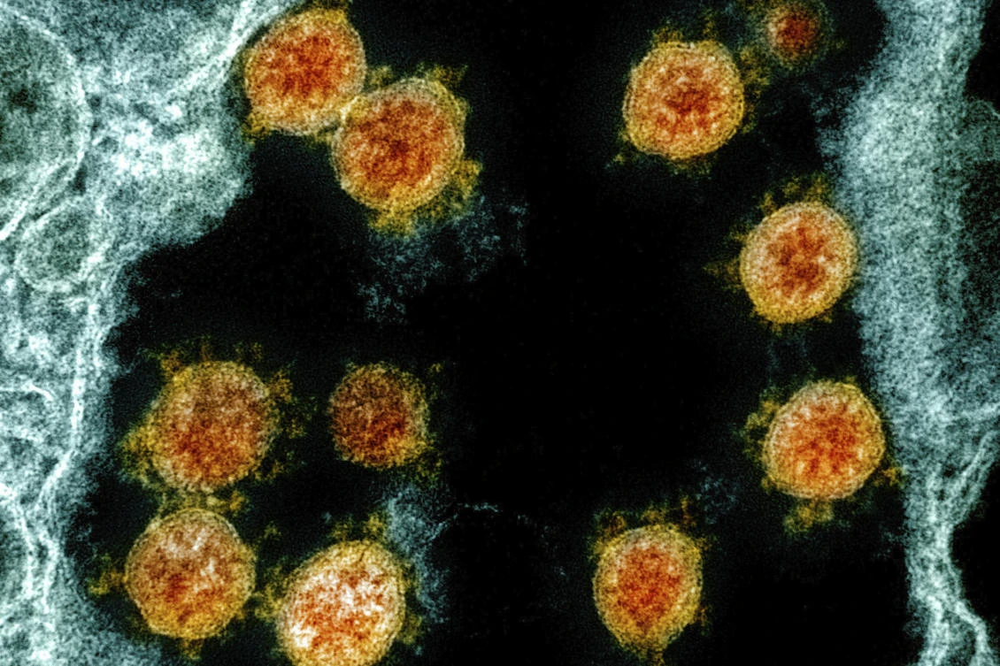 This electron microscope image made available and color-enhanced shows Novel Coronavirus SARS-CoV-2 virus particles, orange, isolated from a patient. (AP)