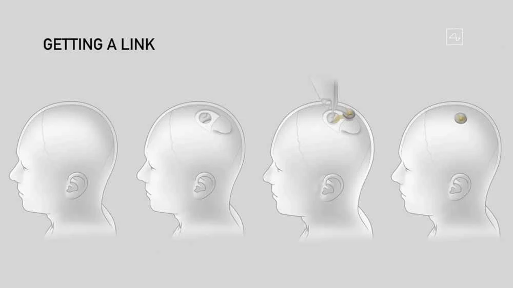 This video grab made from the online Neuralink livestream shows a drawing of the different steps of the implantation of a Neuralink device seen during a presentation on August 28, 2020. (AFP PHOTO / NEURALINK)