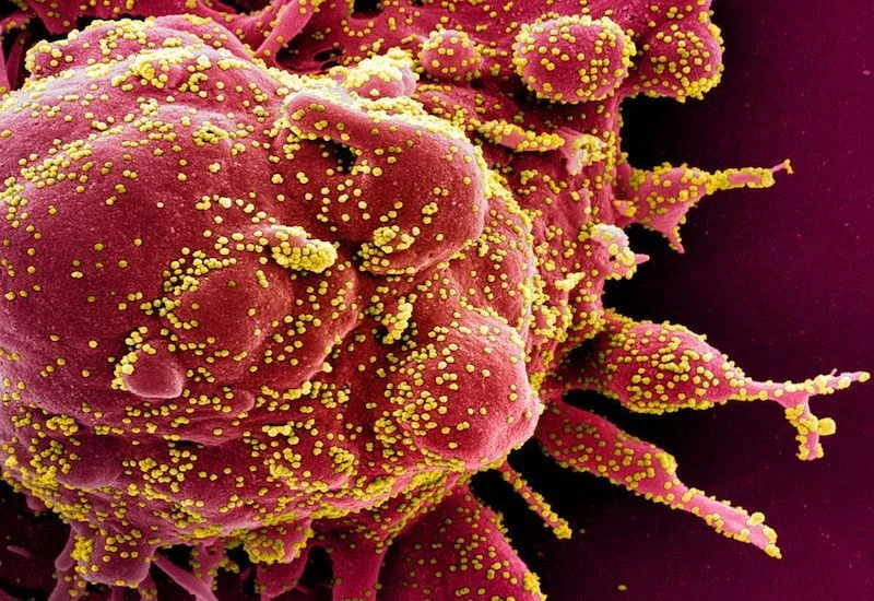 “Long COVID” refers to people suffering from recurring symptoms months after they first contracted the coronavirus. Pictured, a colorized scanning electron micrograph of apoptotic cell infected with novel coronavirus. (NIAID/File Photo)
