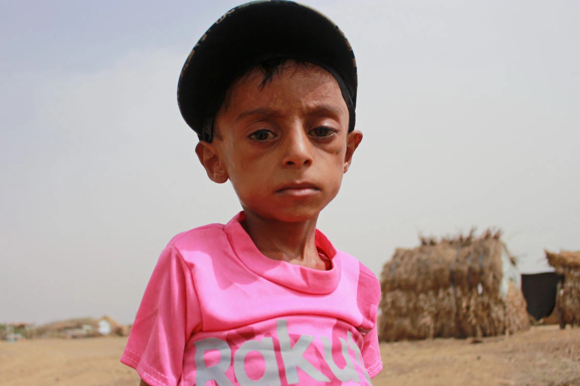 Malnourished boy Hassan Merzam Muhammad, poses for a photo in his village in Abs district of Hajjah province, Yemen July 17, 2020. (File/Reuters)