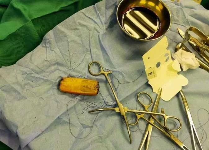 Doctors in Egypt extract mobile phone from patient’s stomach