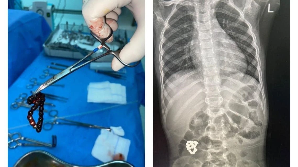 X-ray scans of the child’s body showed a bracelet in his intestines, according to a report by Al Arabiya. (AlArabiya.net)