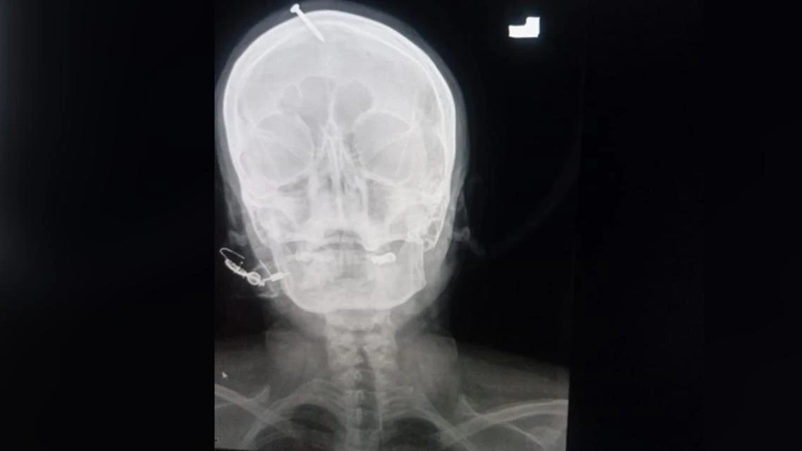 An X-ray showed the five-centimeter (two-inch) nail had pierced the top of the woman’s forehead but missed her brain. (Twitter)