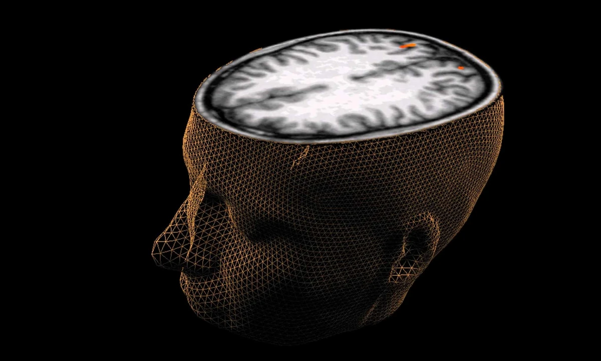 MRI imaging was used to study the brains of people who had recovered from COVID-19. (File/Reuters)