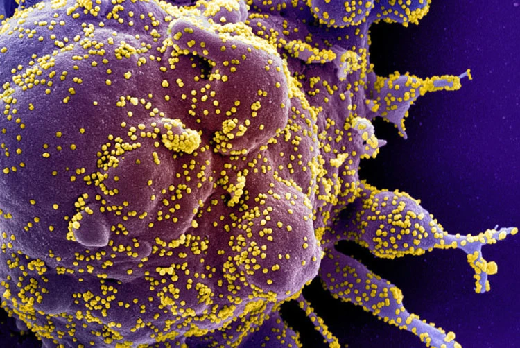 Colorized scanning electron micrograph of an apoptotic cell (purple) infected with SARS-COV-2 virus particles (yellow), also known as novel coronavirus, isolated from a patient sample. (Reuters)
