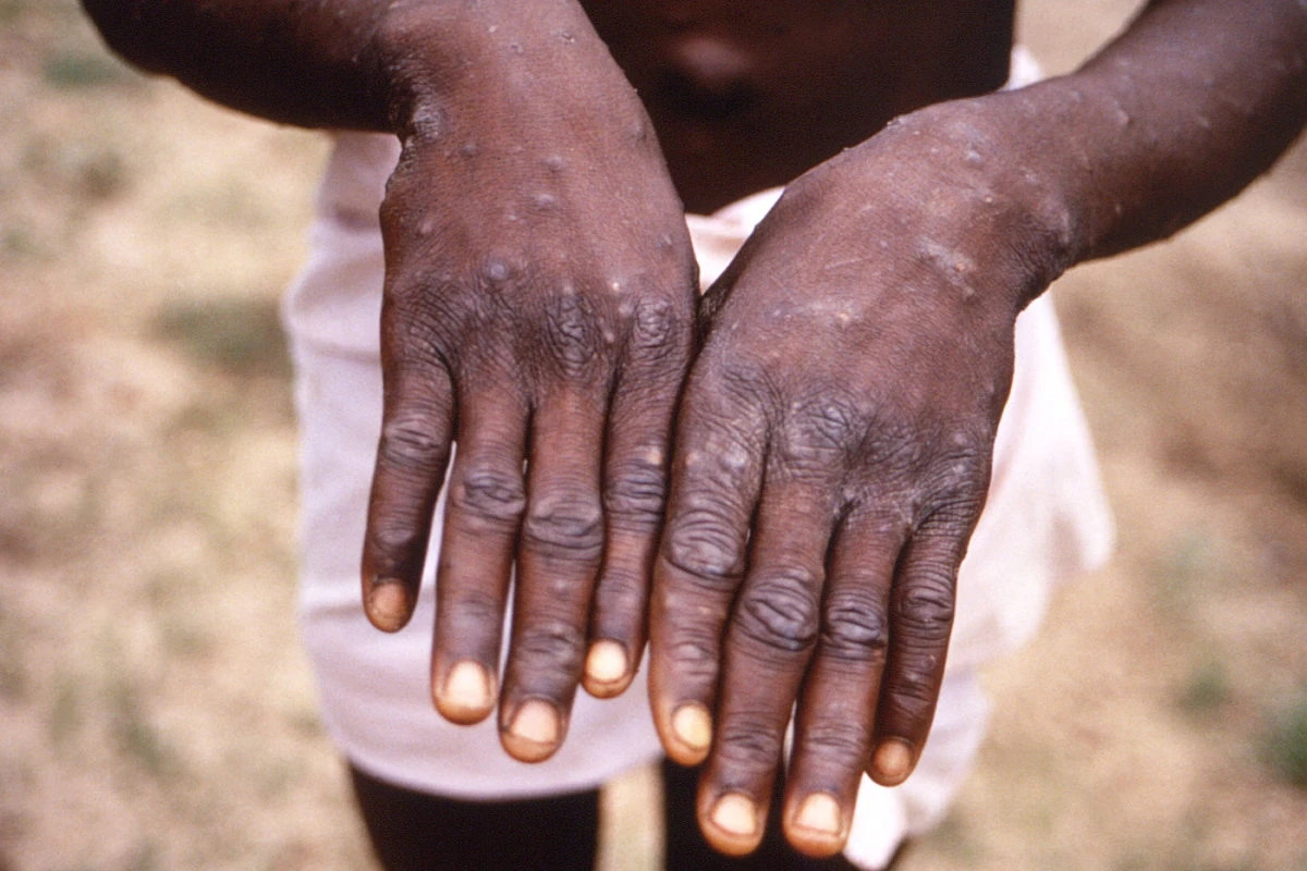 An image created during an investigation into an outbreak of monkeypox in the Democratic Republic of the Congo (DRC) from 1996 to 1997, shows the hands of a patient with a rash due to monkeypox. (CDC Handout via REUTERS)