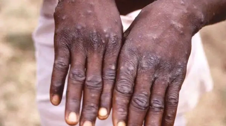 People vaccinated against smallpox likely safe from monkeypox, says specialist‏‏