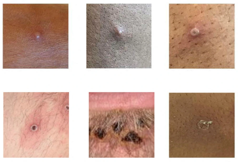 Pictures showing examples of rashes and lesions caused by the monkeypox virus are seen in this handout image obtained from official Centres for Disease Control and Prevention (CDC) website on July 1, 2022. (REUTERS)