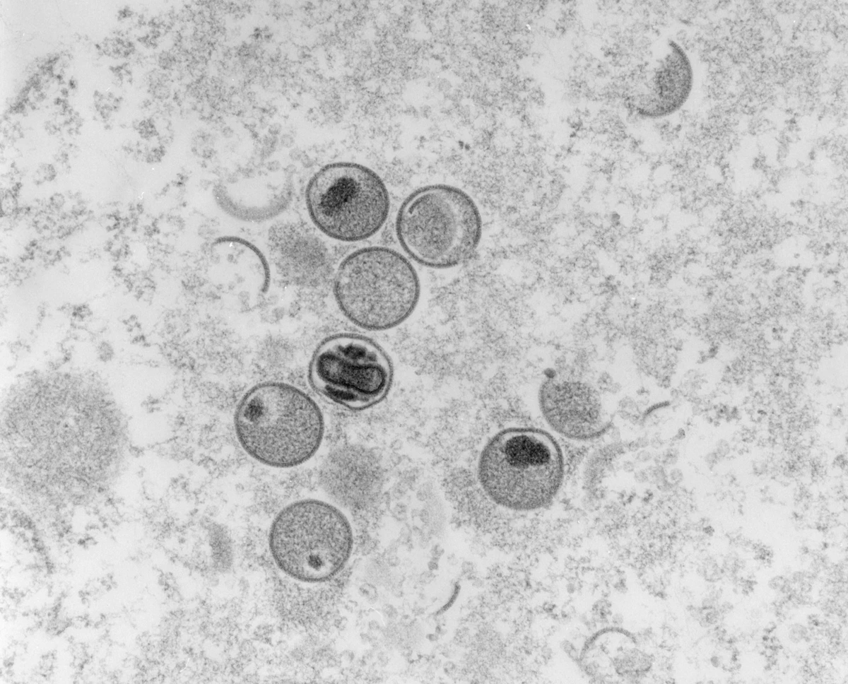 UAE announces 3 new monkeypox cases