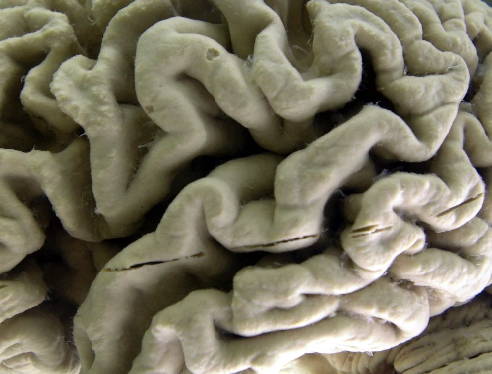 US approves new drug to treat Alzheimer’s
