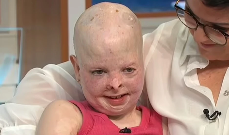 Elizabeth Soffe was two years old when her family’s villa in Al-Waab in Doha caught fire. She suffered third-degree burns to 60 percent of her body. (Screenshot/ITV)