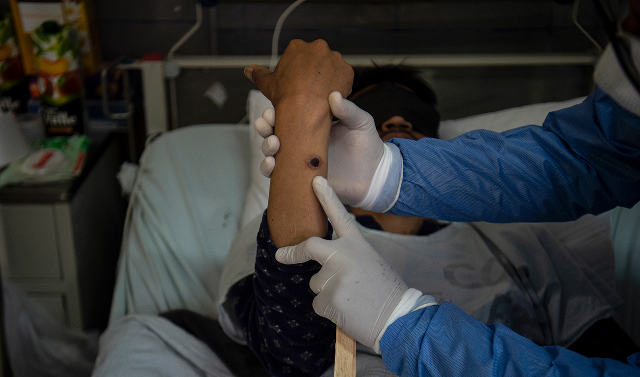 A doctor checks on a patient with sores caused by a monkeypox infection in the isolation area for monkeypox patients at the Arzobispo Loayza hospital, in Lima on August 16, 2022. (AFP/File)