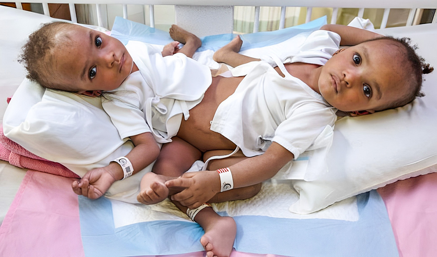 Conjoined twins Hassana and Hassina, who were born in Kaduna, Nigeria on January 12 last year share the abdomen, pelvis, liver, intestines, urinary and reproductive system and pelvic bones. (SPA)
