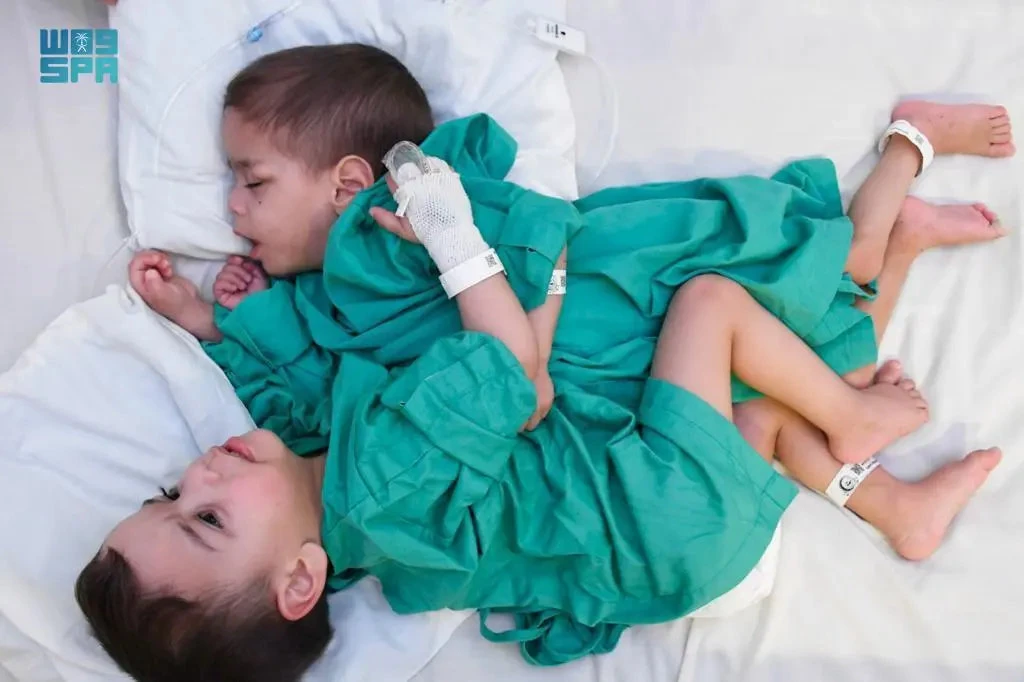 A medical and surgical team is set to separate the Syrian conjoined twin brothers — Bassam and Ihsan. (SPA)