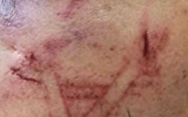 The arrest left the Palestinian man covered with bruises and cut marks on his face. (Israel Police)