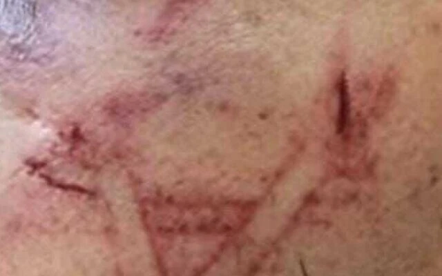 The arrest left the Palestinian man covered with bruises and cut marks on his face. (Israel Police)