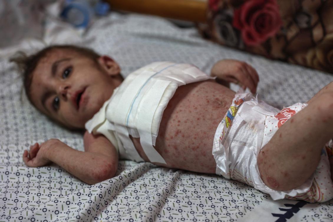 Gaza’s children are already highly vulnerable to disease because their immune systems are compromised by malnutrition, a medical volunteer says. (AFP)